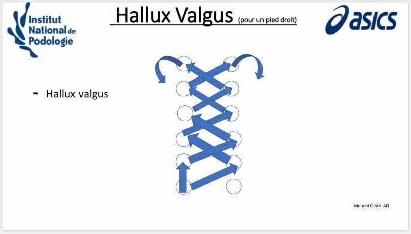Hallux_Valgus_fiche_explicative