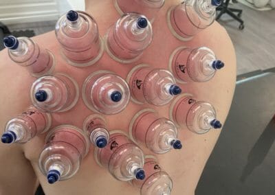 Cupping therapy - Ventousothérapie
