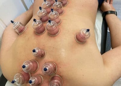 Cupping therapy - Mourad Chahlafi- Cabinet Sébastopol-Lille
