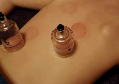 Cupping Therapy - Thérapie par ventouses