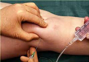 infiltration podologie infiltration podologie genou 4